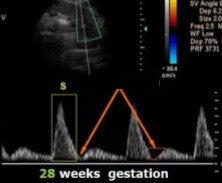 <p>The patient dopplered on is at 28 weeks’ gestation. This is the uterine artery.</p><ol><li><p>Is this waveform normal for how far they are?</p></li><li><p>If not, what 2 pathologies could this indicate?</p></li></ol><p></p>