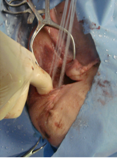 <p>Treatment involves surgical debridement to remove necrotic tissue, sequestrum (piece of dead bone), and foreign material (implants); removal of implants is required to resolve infection if there’s biofilm formation on it. In addition, there should be lavage and drainage of the wound.</p>