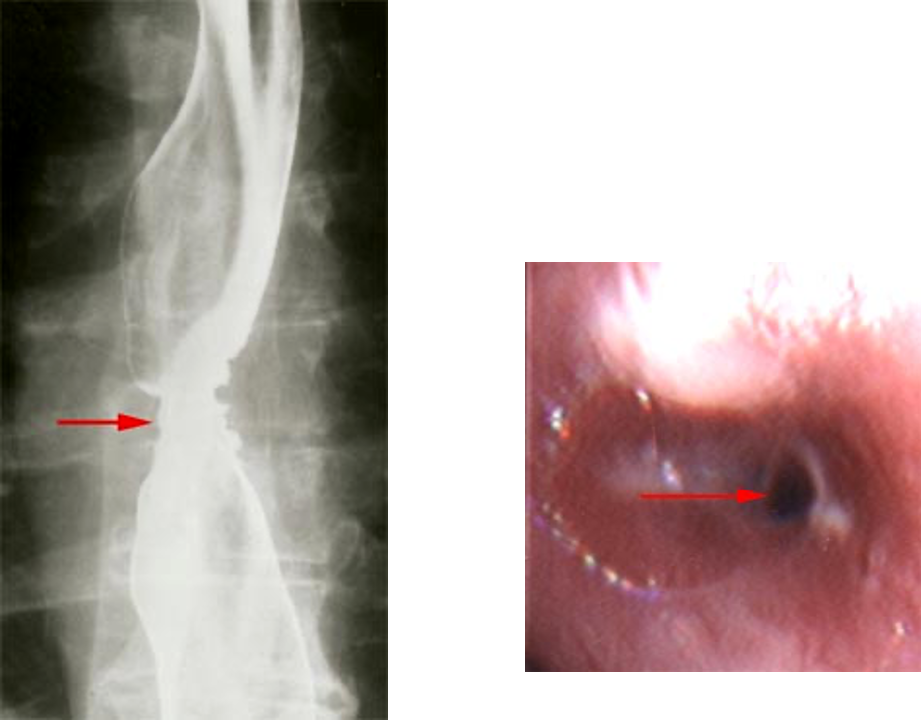 <p>EGD and biopsy</p>