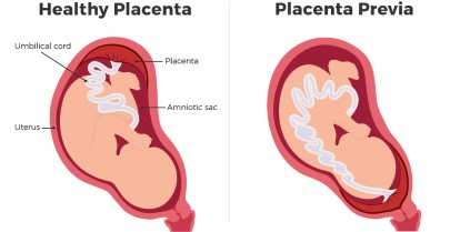 <p>Placenta previa</p>