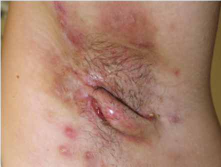 <p>Hidradenitis Suppurativa </p>