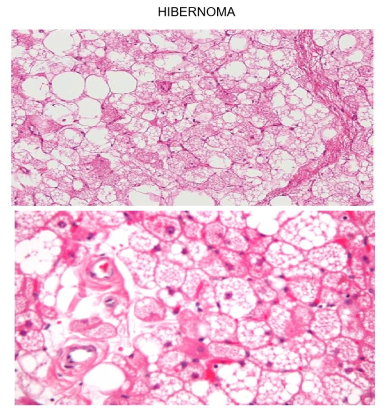 <ul><li><p>niet-frequente tumor</p><ul><li><p>uit bruine vetcellen tumor → goedaardige tumor</p></li></ul></li></ul><p></p>