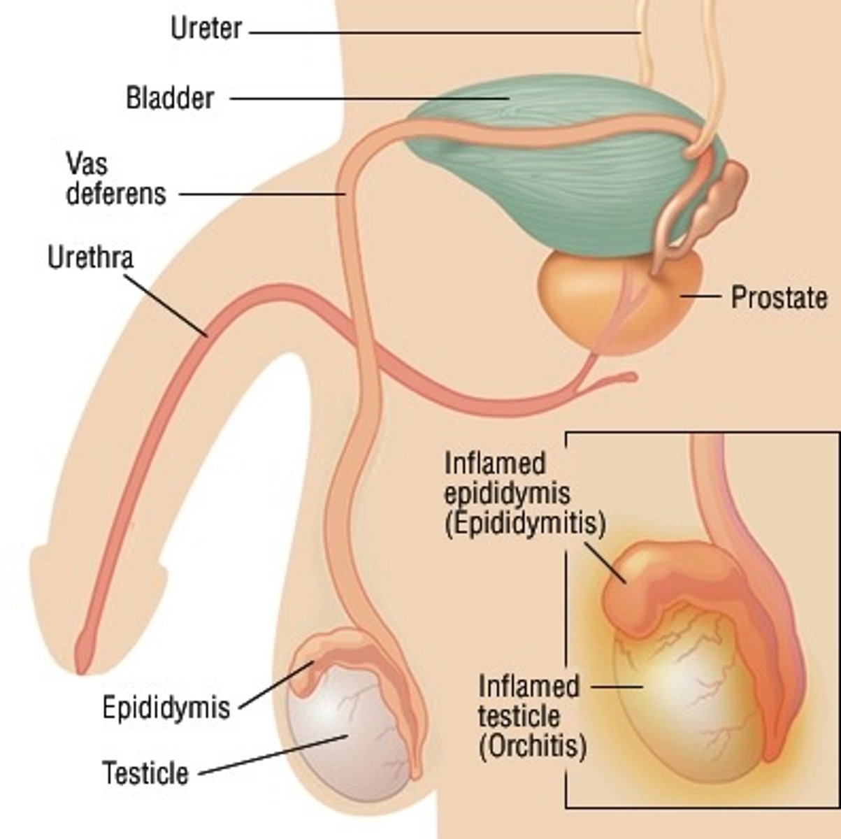 <p>Orchitis (swollen testes)</p>