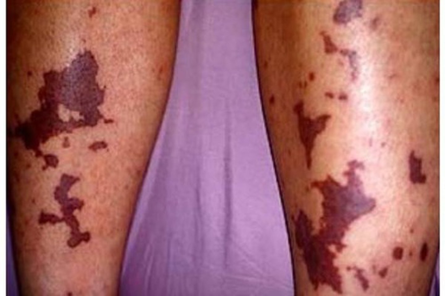 <p>Simultaneous, excessive clot formation AND clot dissolution; life-threatening emergency!!</p>