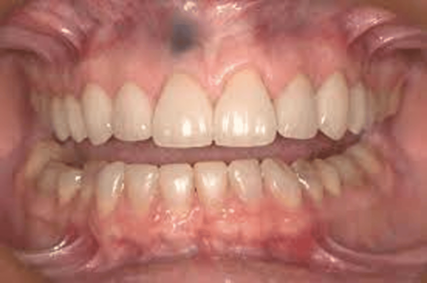 <p>Flat, bluish-gray lesion of the oral mucosa, caused by the introduction of amalgam into tissue; Must be differentiated from malignant melanoma</p>