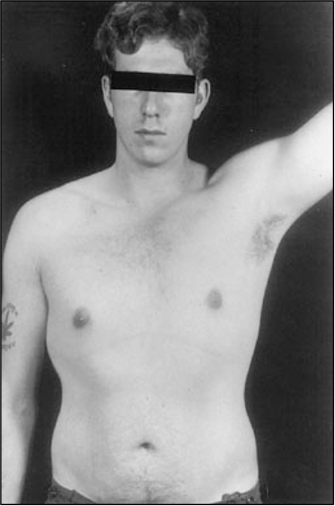 <p>XXY male</p><p>one in every 2000 live births</p><p>have male sex organs, but are sterile</p><p>feminine characteristics</p><p>some breast development</p><p>lack of facial hair</p><p>tall</p><p>normal intelligence</p><p></p>