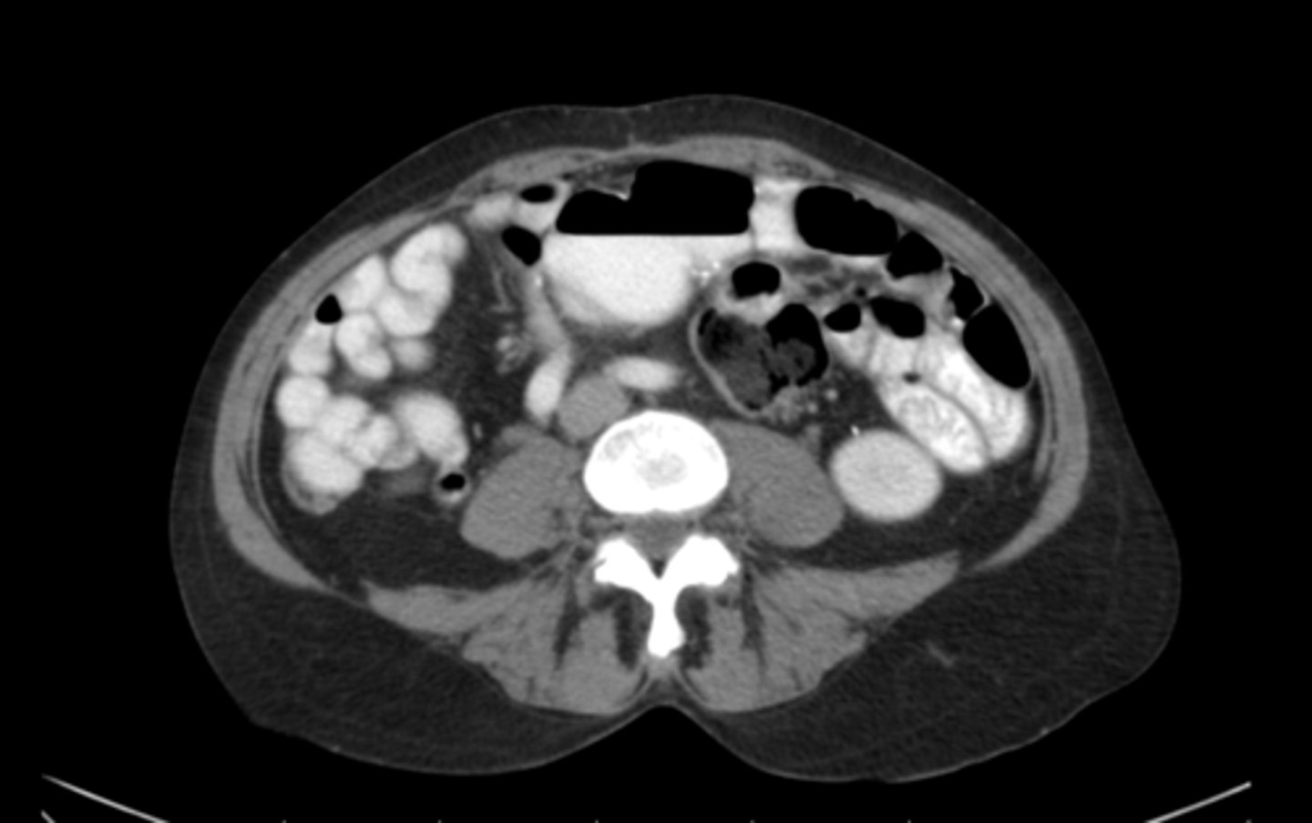 <p>What vertebral level is this and how could you tell</p>
