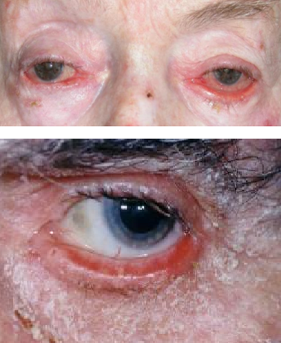 <p>What type of <strong>ectropion</strong> is caused by tightening of the lid skin?</p><ul><li><p>Eczema, rosacea, atopic dermatitis, medications </p></li></ul><p></p>