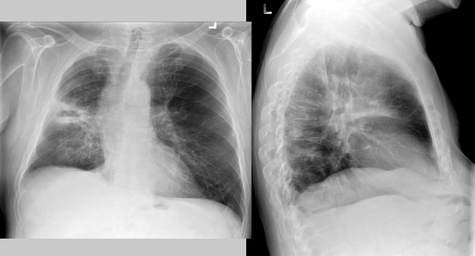 <p>PT presents with fever, cough and foul-smelling sputum<br><br>What pathology is present?</p>