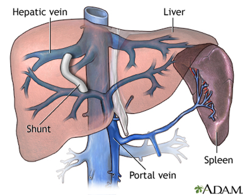 <p>portal decompressive procedures</p><ul><li><p><strong>transvenous intrahepatic portosystemic shunt (TIPS) </strong>→ stabilize pts waiting liver transplant by shunting blood from portal to hepatic vein</p></li><li><p>portosystemic shunt surgery</p></li></ul><p></p>