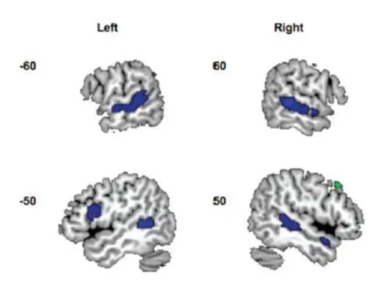 <ul><li><p>Published in 2011 (!!) by Adank et al. and replicated this year by the same group.</p></li><li><p>Interested in neural processing differences of two acoustic variations of Dutch pronounced by same speakers (standard accent and novel, invented accent of Dutch).</p></li><li><p>Adaptation study – examining an “accent switch”.</p></li></ul><p></p><p>The main finding was that the neural bases for processing these two types of distortions dissociated:</p><ul><li><p>Processing speech in background noise resulted in greater activity in the bilateral inferior frontal gyrus (IFG) and frontal operculum.</p></li><li><p>Processing speech in an unfamiliar accent recruited an area in the left superior temporal gyrus/sulcus (STG/STS).</p></li></ul><p></p>