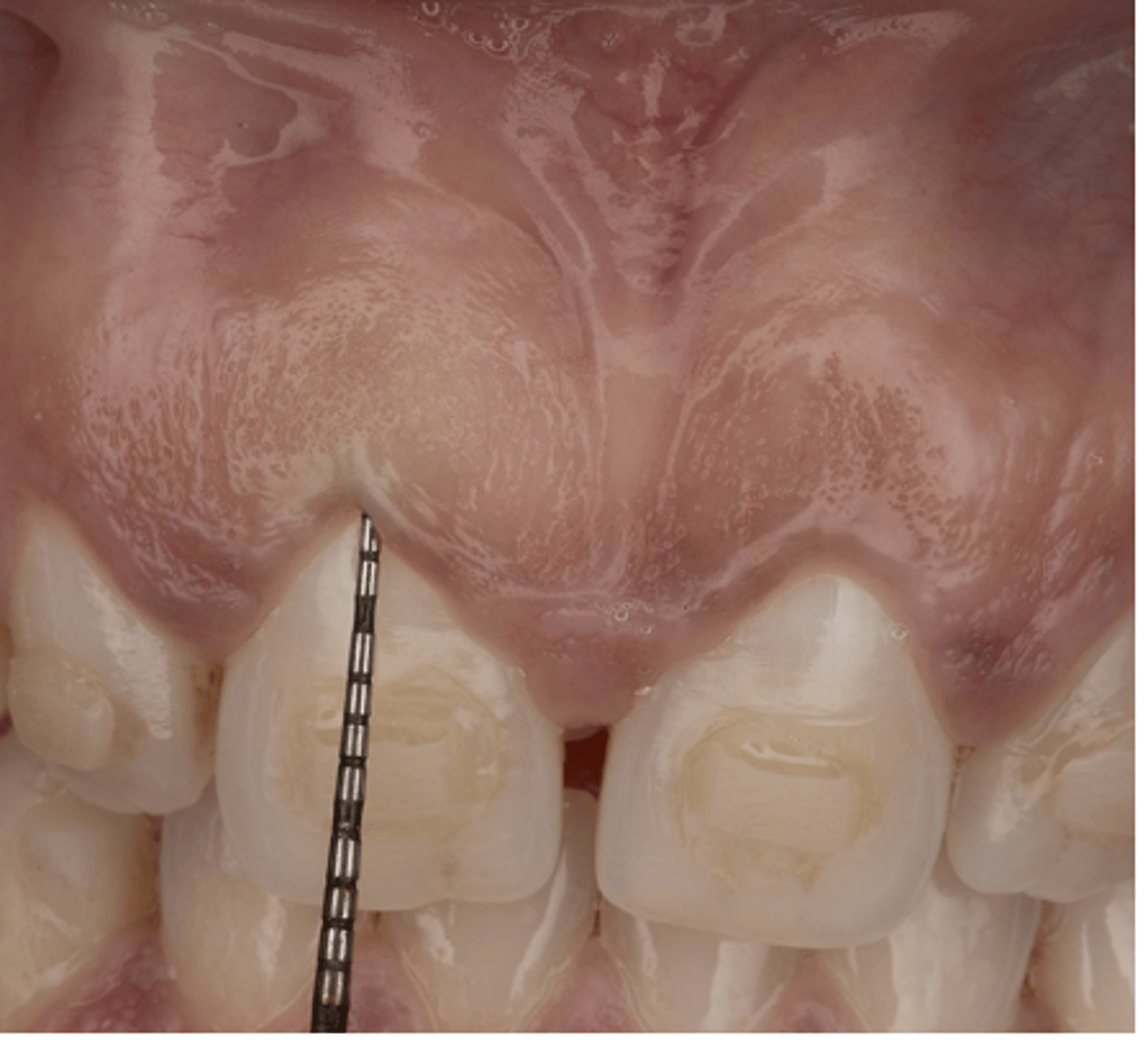<p>The distance from the gingival margin to the bottom of the probeable crevice</p>