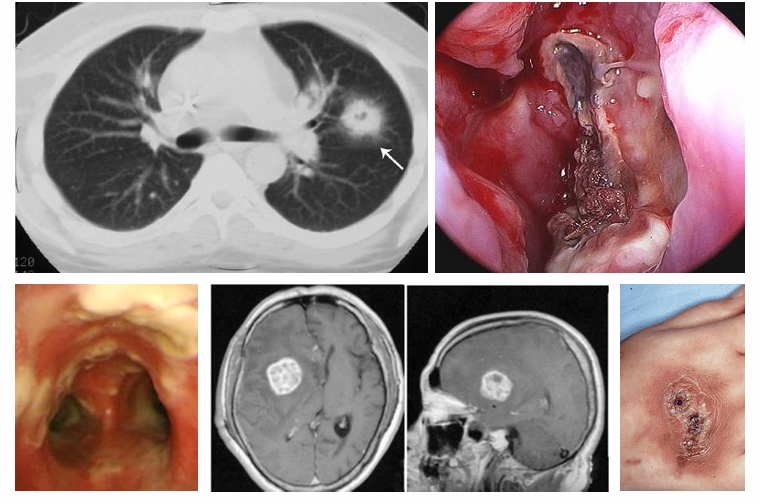 <p>-inhalation of conidia → transfer to alveoli → bind to ECM → invasion with proteases → pneumonia</p><p>-presentation of pneumonia may vary: asymptomatic → fever, cough → hemoptysis, dyspnea, shock; 5-10% of cases also involve the sinuses (present with fever, facial pain, sinus congestion, discharge), tracheobronchial involvement also possible, disseminated disease is rare but deadly- nearly any organ can be affected (brain abscesses, endocarditis, skin)</p>