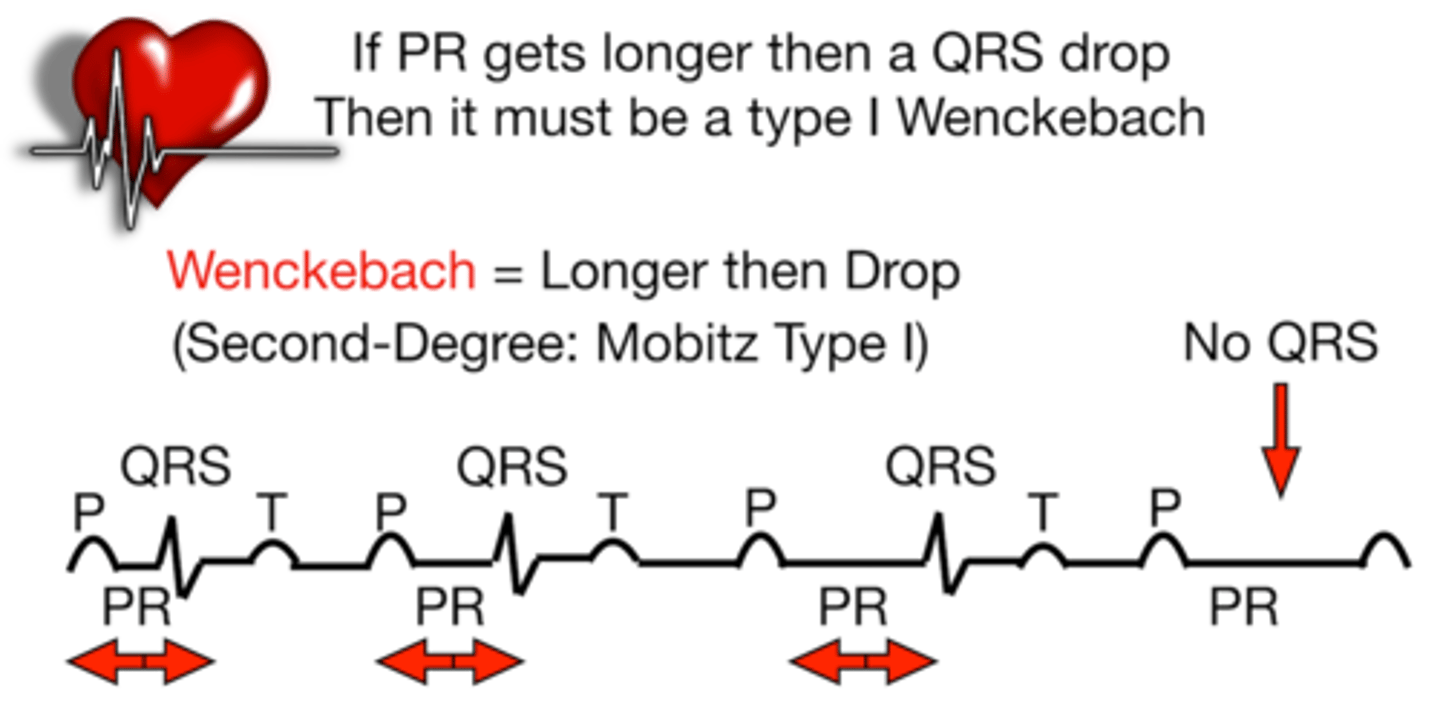 <p>PR interval becomes longer with each succeeding complex until there is a P not followed by a QRS ("marching off")</p>