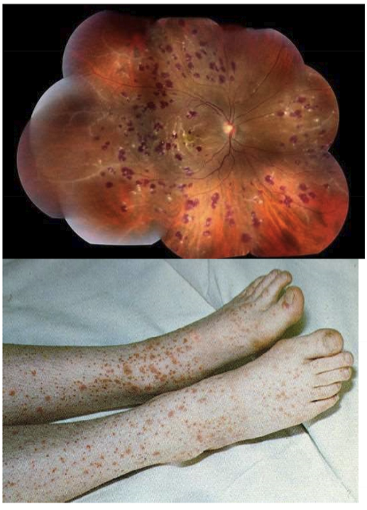 <p>When the patient makes autoantibodies following an infection. It causes petechiae on skin and retina due to capillary hemorrhage. It is a type III hypersensitivity reactions.</p>