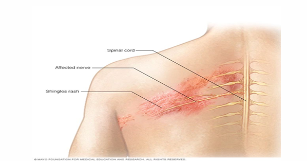 <p>infection of dorsal root ganglion or cranial nerve ganglion with varicella-zoster virus</p><p>affects one dermatome usually</p><p>virus irritates and inflames nerve, causing pain</p><p>skin lesions around affected area</p>