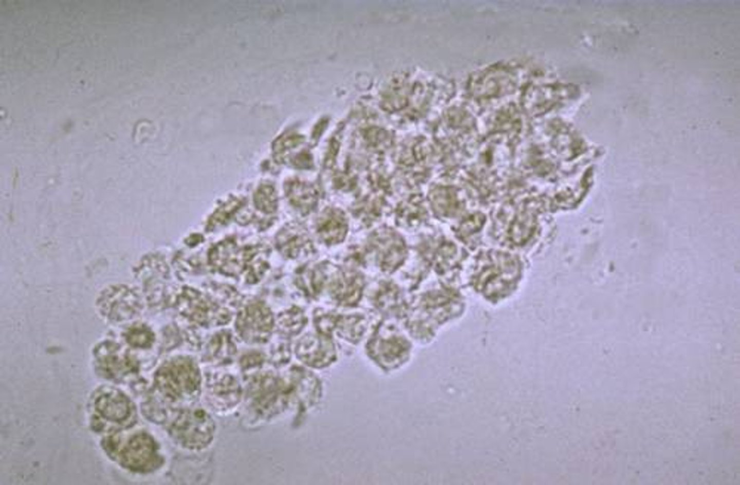 <p>Signifies infection or inflammation within the nephron. Most frequently seen with pyelonephritis and are primary markers for distinguishing pyelonephritis from cystitis.</p><p>Most casts consist of neutrophils, therefore they appear granular and unless disintegration has occurred, multi-lobed nuclei will be present</p><p>Will have irregular boarders and need to be observed for the cast matrix</p>
