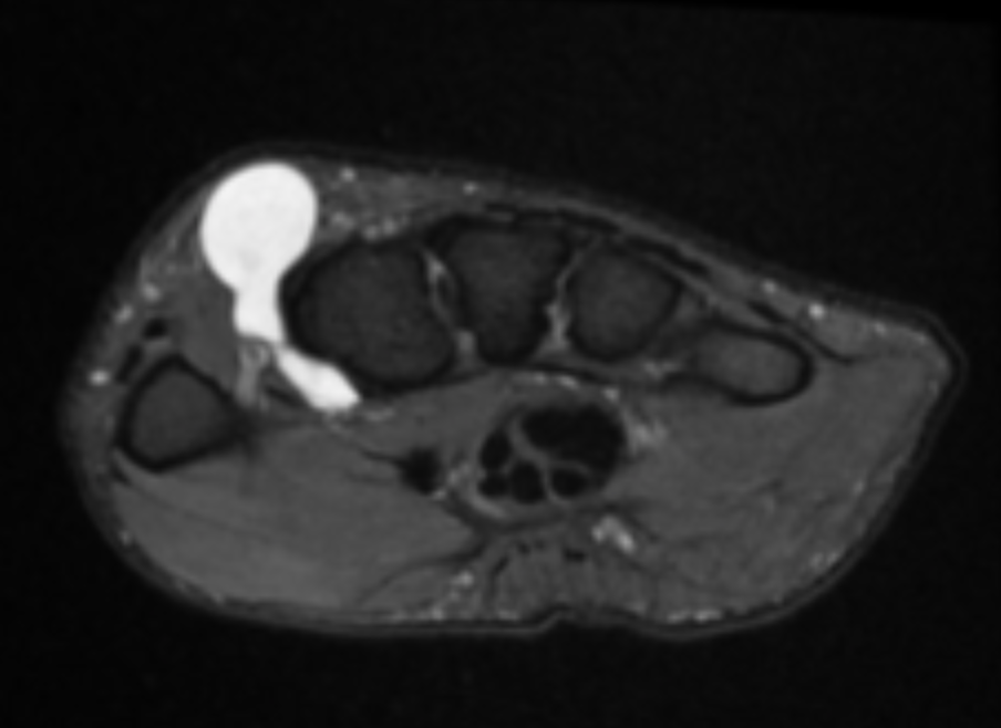 <p>Describe the pathology indicated by the arrow (Ax T2 FS). </p>