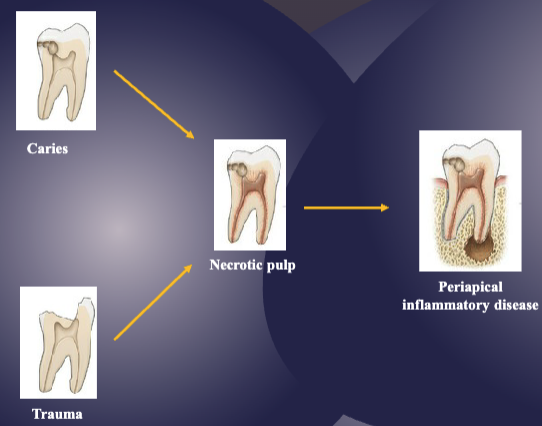 <p>caries/trauma → necrotic pulp → periapical inflammatory disease&nbsp;</p>