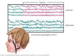 <p>EEG (electroencephalogram)</p>