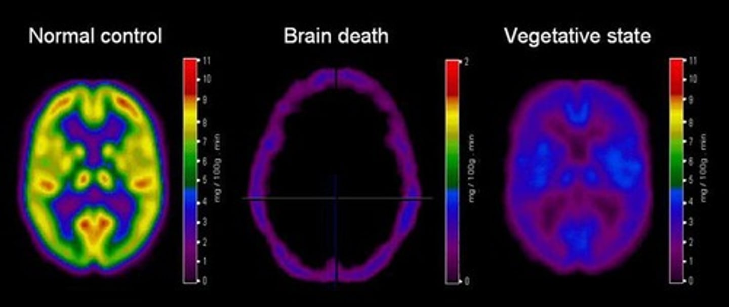<p>A condition where the body is alive but the brain is no longer able to regulate body functions.</p>