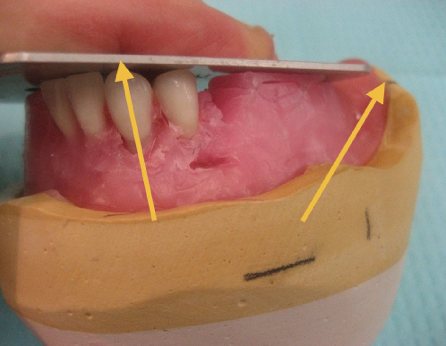 <p>What does this step show when placing the mandibular premolars?</p>