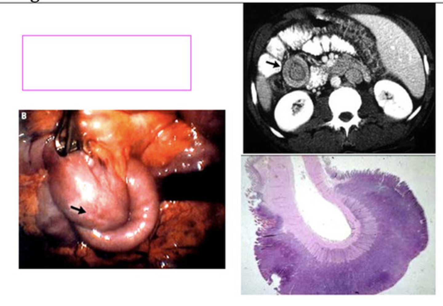 <p>1.) B) Anemia and hypoalbuminemia</p><p>2.) B) CT enterography</p><p>3.) B) Endoscopic biopsy of the mass</p>