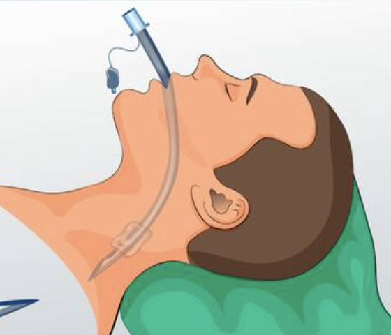 <p>ETT (endotracheal)</p>