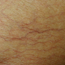 <p>caused by dilation of blood vessels that are visible on the skins surface</p>