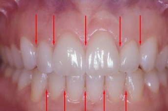 <p>Interdental papilla </p>
