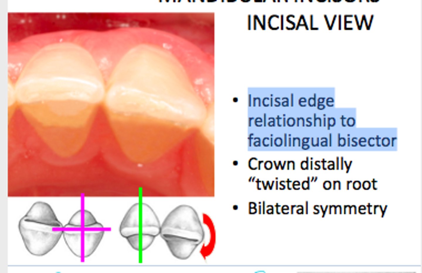 <p>1. barely noticeable cingula</p><p>2. the incisal edge is lingual to root axis</p><p>3. continuous convexity on facial</p>