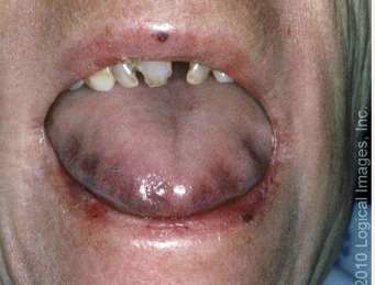 <p><span style="color: #000000">Abnormally large tongue, most frequently caused by:</span></p><ul><li><p><span style="color: #000000">Vascular malformations</span></p></li><li><p><span style="color: #000000">Muscular hypertrophy</span></p></li><li><p><span style="color: #000000">Other etiologies: Down syndrome,</span><span style="color: #000000"><br></span><span style="color: #000000">amyloidosis, angioedema, tumors</span></p></li></ul><p></p>