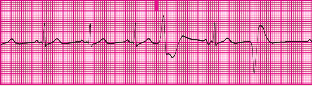 <p>Varied shapes and forms of the PVCs, suggesting more than one irritable focus</p>