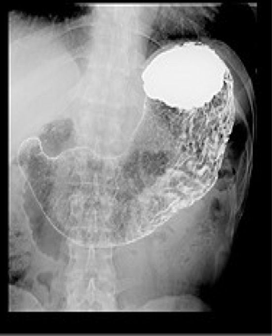 <p>Evaluation of the esophagus, stomach, and duodenum using oral contrast.</p><p>Detect polyps, masses, malpositioned bowel, motility problems, GE reflux, and hiatal hernia</p>