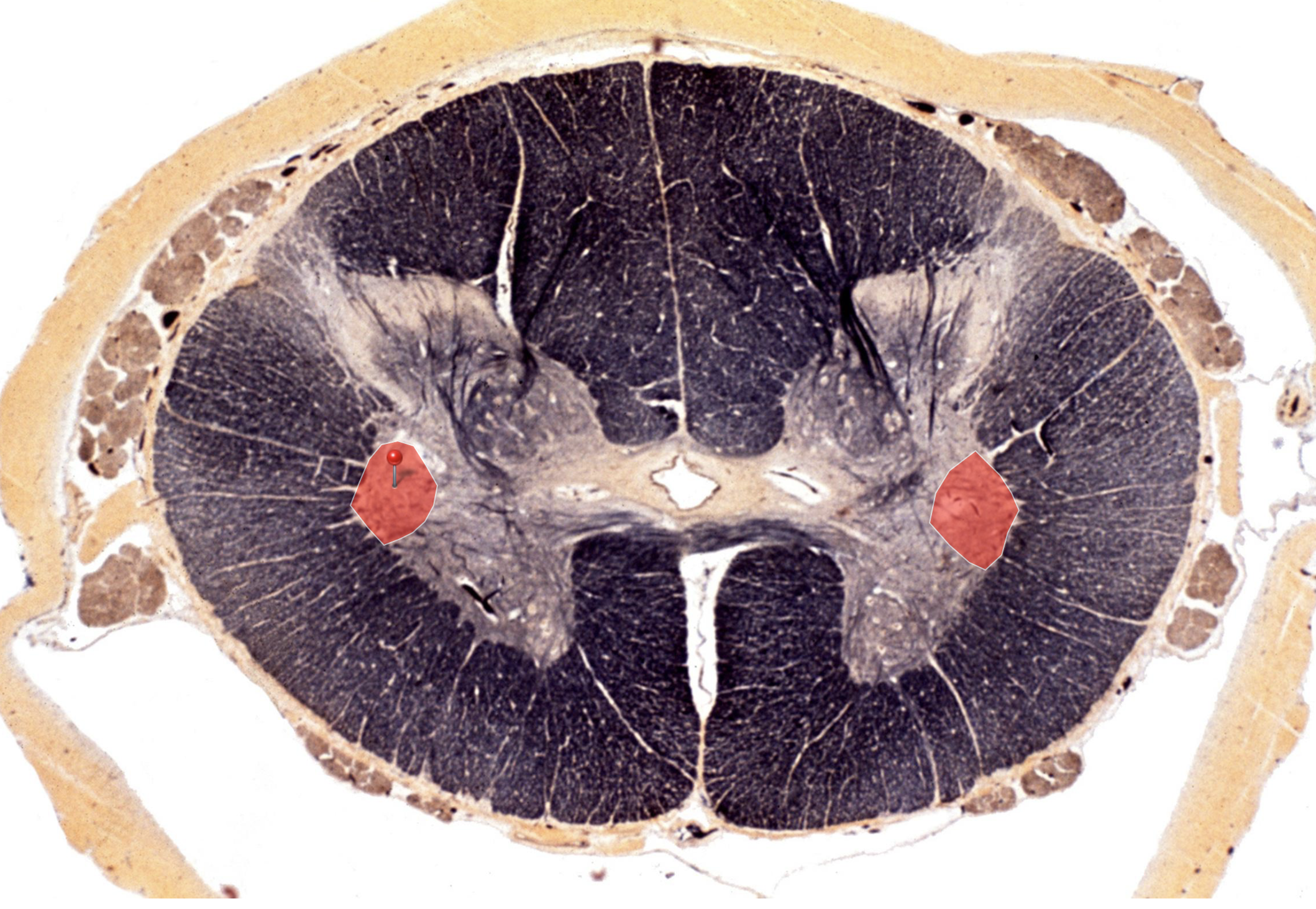 <p>Lateral Horn </p><p></p><p>Indicative of a thoracic or <strong><u>upper lumbar</u></strong> cross section</p><p>Upper Lumbar due to <strong><u>larger grey matter</u></strong></p>
