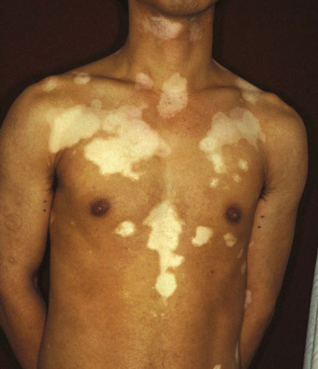 <p>localized loss of skin pigmentation characterized by milk-white patches</p><p>- also called leukoderma</p>