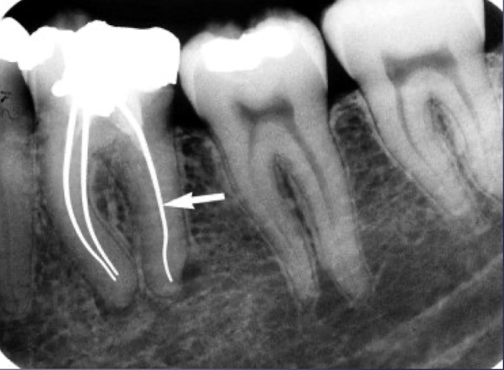 <p>which restorative material?</p>