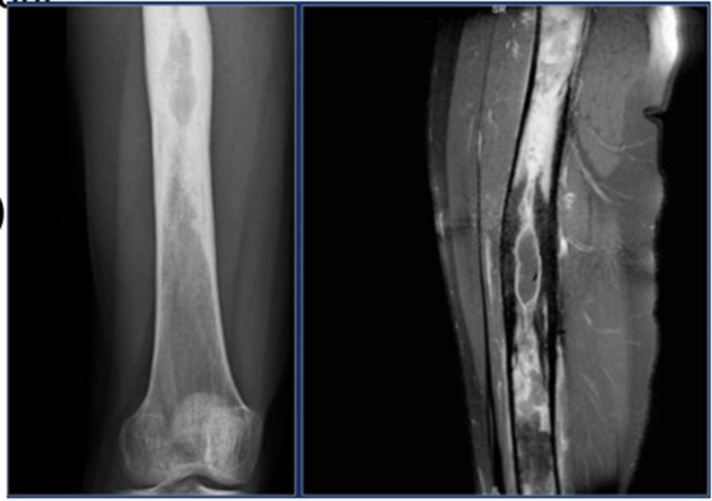 <p>Acute or chronic infection of the bone and marrow</p><p>Pyogenic - Staphylococcus aureus is most common cause</p><p>-- Hematogenous- Originates with infectious organisms that reach the bone through the bloodstream.</p><p>-- After open fracture, bacteria from patient’s skin run high risk of establishing colonies inside the bone</p><p>Symptoms:</p><p>- Bacteremia (chills, fever, malaise)</p><p>- Bone lesion (pain, reduced motion)</p><p>Treatment:</p><p>- Identify causative organism</p><p>- Treat organism (e.g., antibiotic)</p><p>- Rest &amp; pain management</p><p>Possible drainage</p>