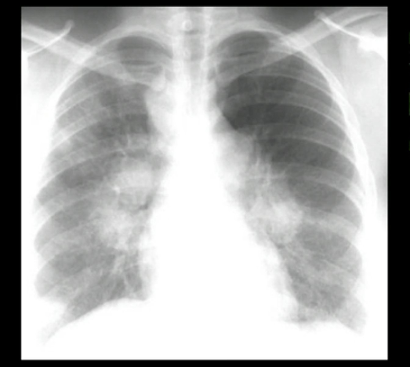 <p>sarcoidosis</p>