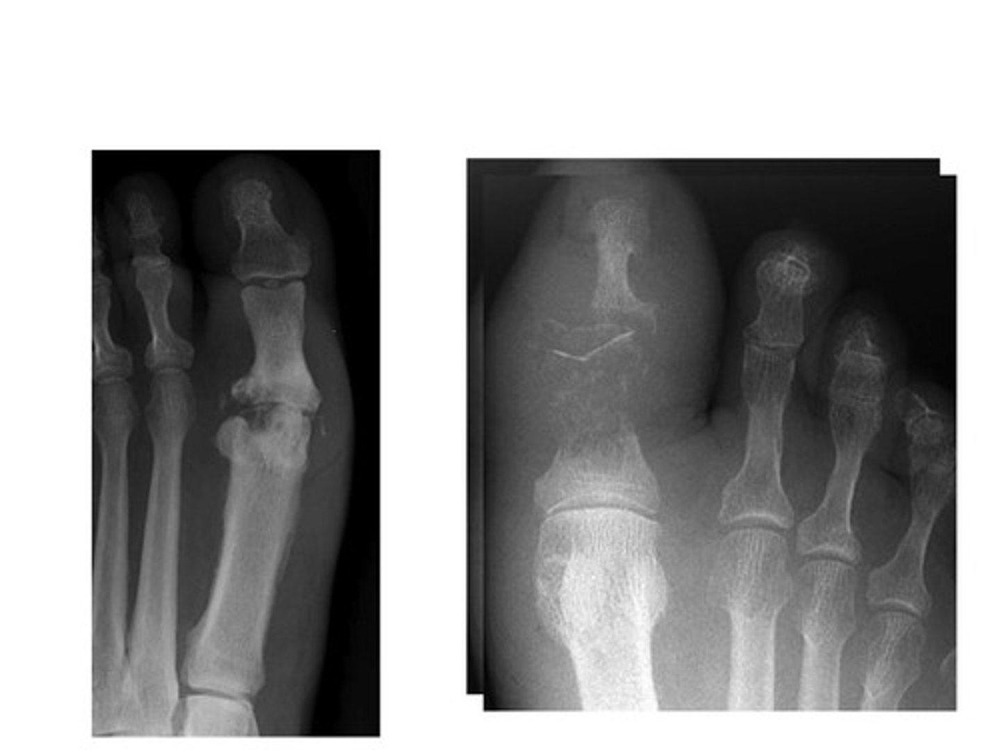 <p>infection of the bone</p>