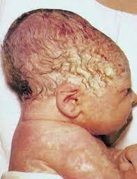 <p>deuk tgv druk tijdens partus</p>