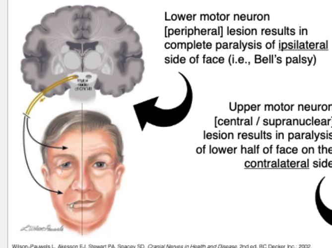 <p>Entire <strong>ipsilateral side</strong> <span style="color: red;">paralysis</span> (i.e bell’s palsy)</p>