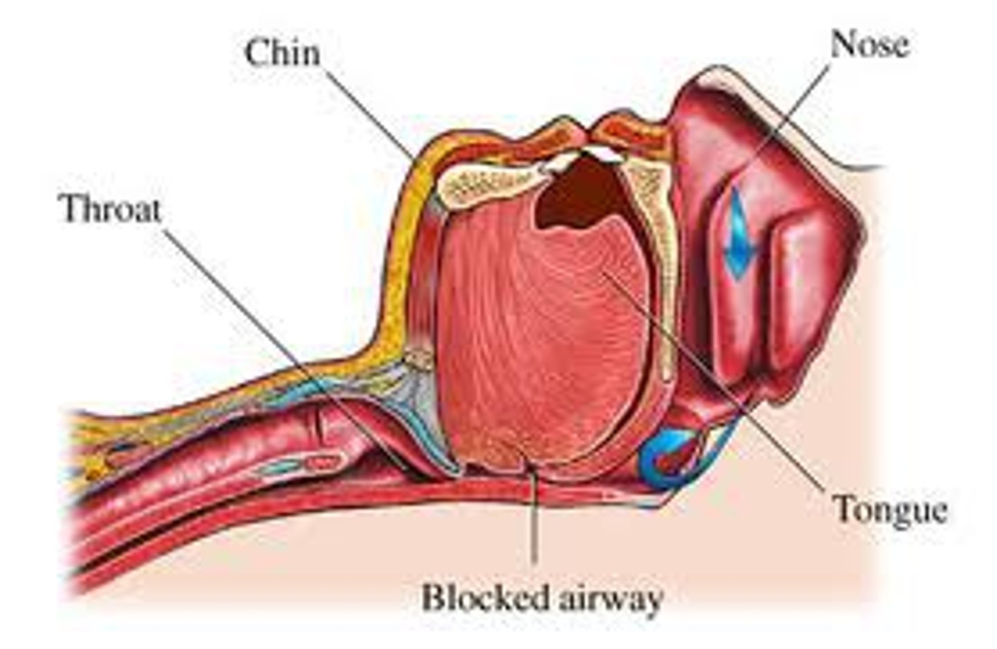 <p>a sleep disorder characterized by temporary cessations of breathing during sleep and repeated momentary awakenings</p>