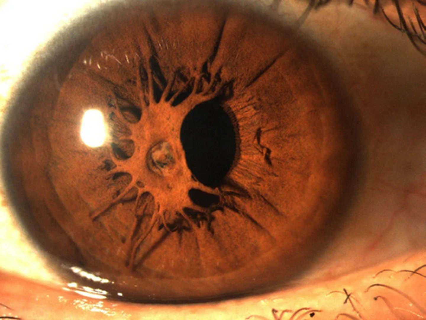 <p>persistent pupillary membrane</p>