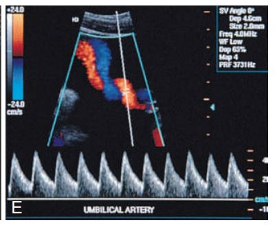 <p>Spectral Doppler shows____ umbilical artery flow in a fetus with a two-vessel cord.</p>