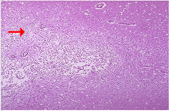 <ol><li><p>Identify what type of cell death and CD</p></li><li><p>What happens to the liquefied area when it resolves?</p></li></ol>