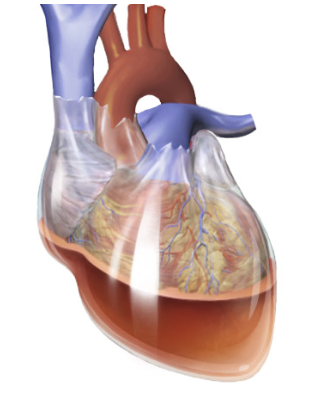 <p><span><span>a potentially fatal situation when blood or fluid accumulates in the pericardium. </span></span></p><ul><li><p><span><span>This compresses the heart, preventing the ventricles from expanding fully and impeding it’s blood supply.&nbsp;</span></span></p></li></ul><p></p>