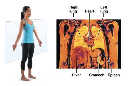 <p>A ____ MRI illustrates the front aspect of the thorax, the heart, lungs, liver, stomach, and spleen</p>