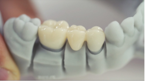 <p>A highly accurate replica of a single tooth, used for making crowns or inlays.</p>