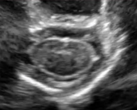 <p>Is this transverse image normal or abnormal?</p>